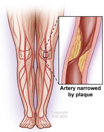 artery blocked by plaque